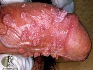Virus del Papiloma Humano VPH - Dr. Sendic Villatoro