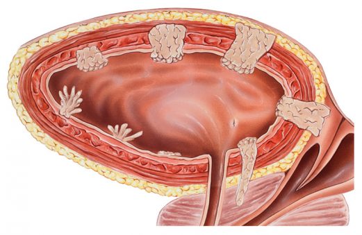 Ultrasonido de cáncer de vejiga