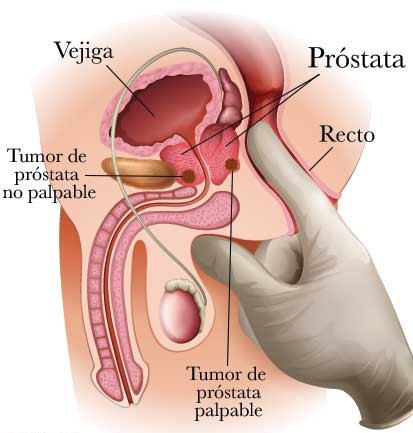 cancer de prostata que es