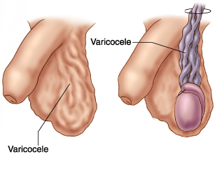 Varicocele - Dr. Sendic Villatoro